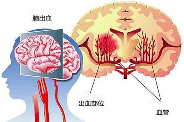 男子酒足饭饱后突发脑干出血，一场突如其来的健康警钟